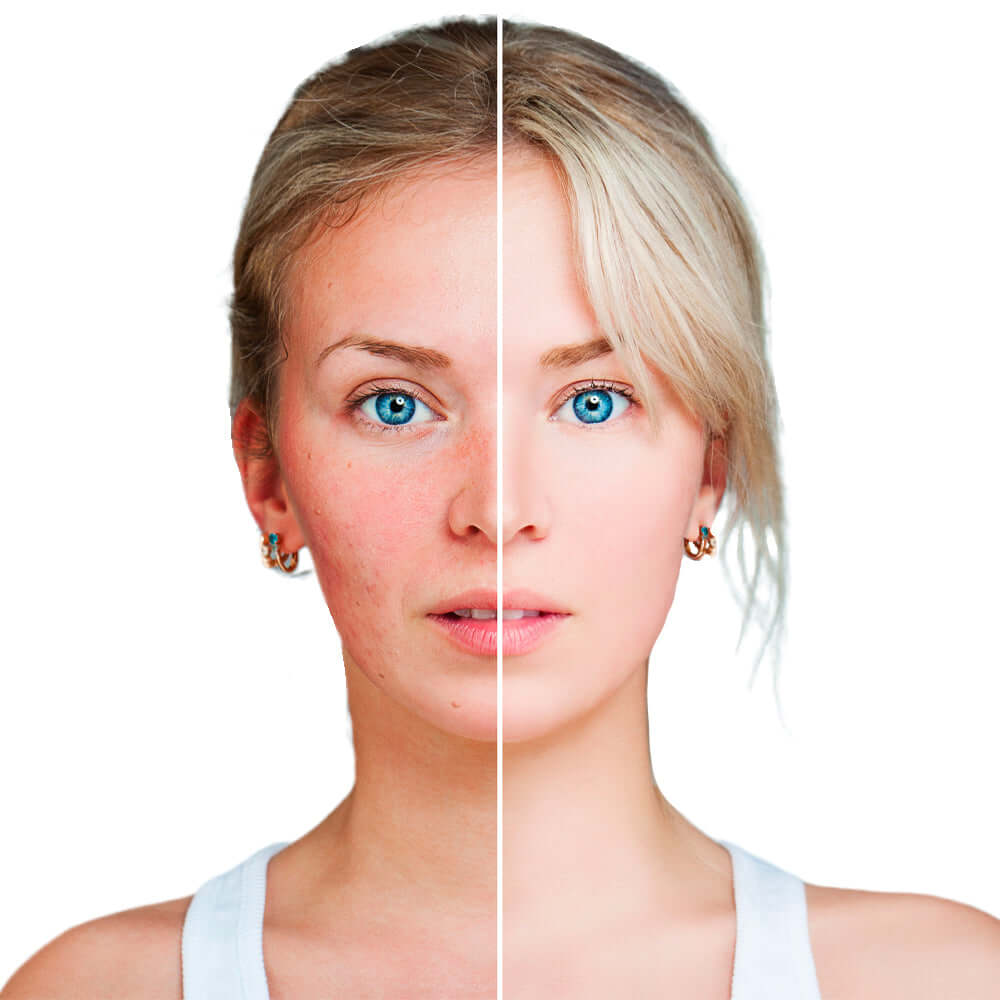 Ruddy Skin and Rosacea & Coverage